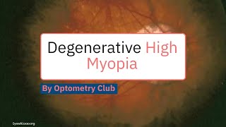 Degenerative Myopia  Pathological High Myopia [upl. by Aivun]