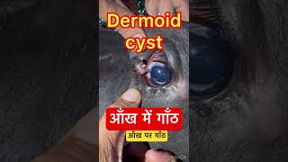 Dermoid cyst l dr Umar khan [upl. by Elboa889]