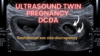 Ultrasound twin pregnancy gestational sac discrepancy Dichorionic diamniotic twin pregnancy [upl. by Bauer81]