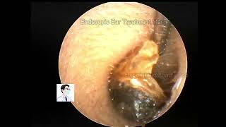 Ear wax removal Common cerumen embolic processing [upl. by Ahsitel988]