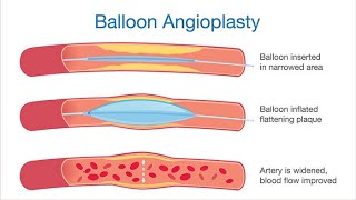 Balloon Angioplasty Surgical procedure  Definition Types Indications Techniques Advantages [upl. by Anav871]