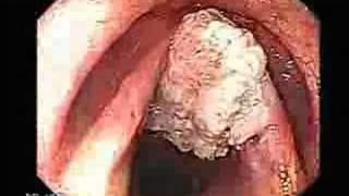 Cancer of the larynx vocal cords cancer [upl. by Forest]