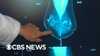 FDA plans new mammogram regulations to support women with dense breasts [upl. by Pooh108]