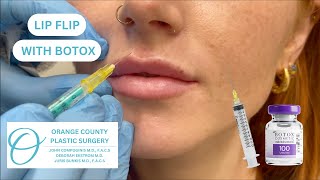 Lip Flip with Botox botox lipflip botoxlipflip botoxtreatment botoxinjections botoxfiller [upl. by Enram]