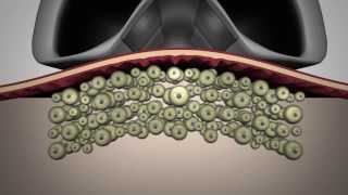 LipoContrast  One step beyond cryolysis [upl. by Iuq]