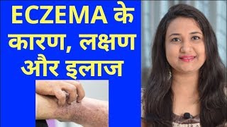 Eczema का इलाज । Eczema best treatment in hindi [upl. by Elodea468]