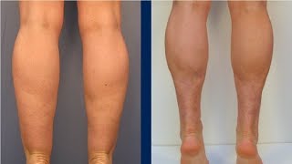 how to get rid of cankles if you are skinny [upl. by Ehsiom]