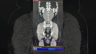 Above CECT findings reveals grade I prostatomegaly with left simple cortical renal cyst as describ [upl. by Lrigybab]