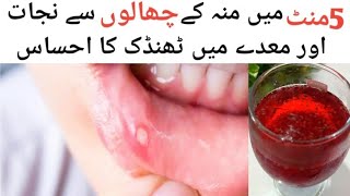 muh ke chhale ka ilaaj  home remedies for mouth ulcers in hindi  5 منٹ میں منہ کے چھالوں سے نجات [upl. by Ardnasirk742]