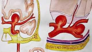 Understanding Brain aneurysm and endovascular coiling [upl. by Ephram]