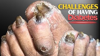 Challenges of Having Diabetes [upl. by Lynea]