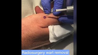 Warts on hand removal by radiosurgery at Cosmedics Skin Clinics London amp Bristol [upl. by Adnara]