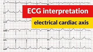 Electrical cardiac axis ECG interpretation [upl. by Llekcm]