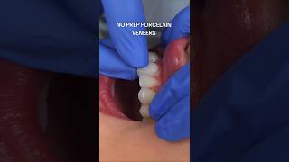 INSTANT Veneers With NO Teeth Damage [upl. by Seena]