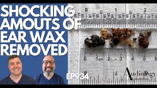 SHOCKING AMOUNTS OF EAR WAX REMOVED  EP934 [upl. by Jew]