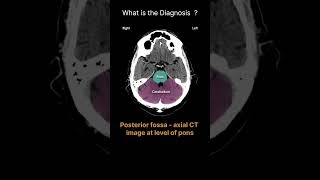 Posterior fossa  axial CT image at level of pons CT Brain Anatomy Quiz 30radiologychannel007 [upl. by Dixon920]