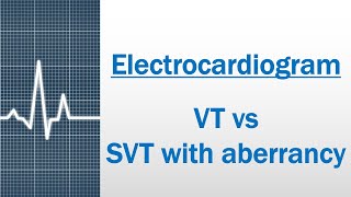 VT versus SVT with aberrancy Electrocardiogram [upl. by Gnohc701]