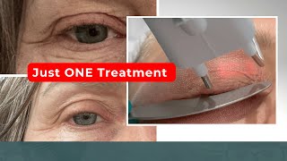 The BEST NonSurgical Eye Lift Treatment for Hooded Eyelids [upl. by Bauer]