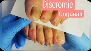 Unghie ispessite tutorial step by step Pedicure di anziani e come risolvere [upl. by Corinna122]