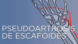 Pseudoartrosis de escafoides  fractura de mano mal curada  IQTRA [upl. by Gerta300]