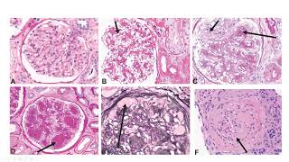 Basics of Renal Pathology  Diabetic Nephropathy [upl. by Tioneb]