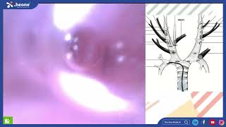 Bronchoscopic Bronchoalveolar Lavage BAL Surgeon Dr 鄒天思 [upl. by Narda]