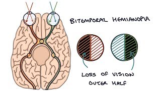 Understanding Bitemporal Hemianopia [upl. by Anenahs]