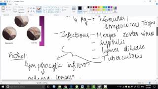 episcleritis  ophthalmology [upl. by Heilman23]