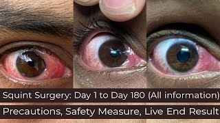 My Story  Before and After SquintStrabismus Surgery Day 1 to Day 180 [upl. by Erina473]