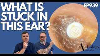 WHAT IS STUCK IN THIS EAR  EP939 [upl. by Enilrac]