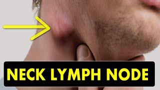 NECK LYMPH NODES  CAUSES and TREATMENT [upl. by Koch]