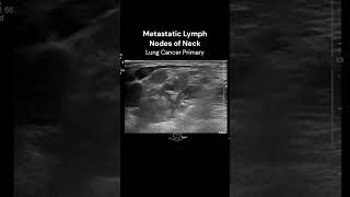 Neck Lymph Nodes ultrasound imaging cancerawareness cases [upl. by Gonnella]