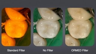 ORMED Filter Introduction  Optimal Light Source in Composite Restoration [upl. by Iretak]