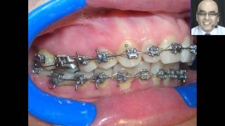 Pegado de Brackets y Tubos en las Tecnicas Individualizadas 2 [upl. by Llerrehs]