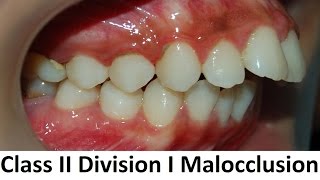 Can Class II Division I of Malocclusion Be Treated With Orthotropics by Prof John Mew [upl. by Ingraham]