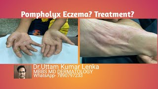 What is pompholyx eczema reason and Treatment of itchy vesiclesblisters on palms and soles [upl. by Constant]