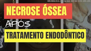 CASO GRAVE DE NECROSE ÓSSEA POR EXTRAVASAMENTO DE HIPOCLORITO DURANTE TRATAMENTO DE CANAL [upl. by Burnley188]