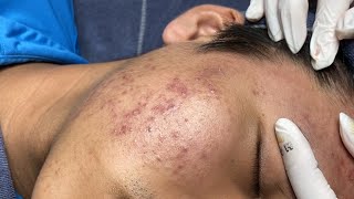 ACNE TREATMENT VU QUYNH MI  Perennial Blackheads On Boy Face 2024FULL [upl. by Kiley680]