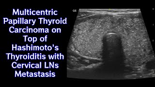 Multicentric Papillary Thyroid Carcinoma on Top of Hashimotos Thyroiditis with Cervical LNs Mets [upl. by Mile]