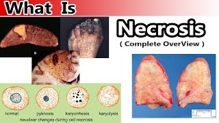 What is Necrosis  Complete Overview [upl. by Ruenhcs]