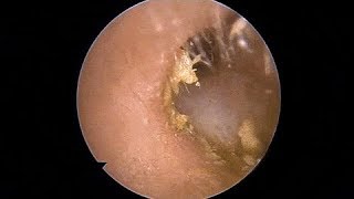 Milia Removal The first person to clean earwax after 35 years of life 02 [upl. by Adnahsed]