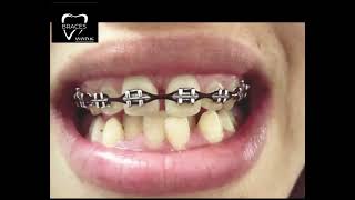 BIMAXILLARY PROTRUSION  BRACES 917006740026 anantnag dentistry health aestheticsyoutube trend [upl. by Nattirb]