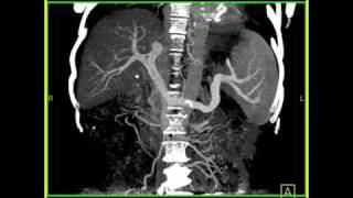 Abdomen Liver Cirrhosis MIP Maximum intensity projection of a cirrhotic liver with collaterals [upl. by Cuthbertson320]