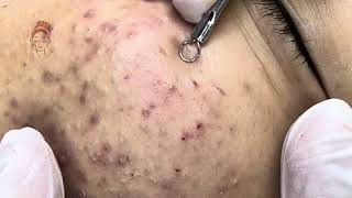 Relax Every Day acne pimplepopping blackheads [upl. by Jillie]