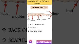 PRESSURE ULCERS amp COMMON SITES FOR PRESSURE ULCERS [upl. by Mauer]