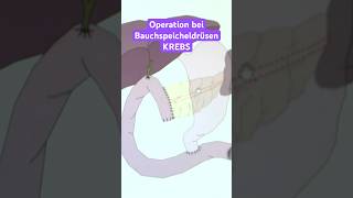 Operation bei Bauchspeicheldrüsenkrebs  Asklepios shorts [upl. by Hurlee507]