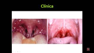 Faringoamigdalitis Agentes infecciosos Dx diferencial Viralbacteriana Tratamiento Infectología [upl. by Branham]