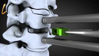 Hernie discale cervicale  Spinal disk herniation  Kisco International [upl. by Adniral]