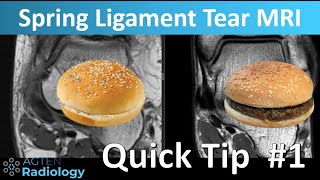 Quick tip 1 Spring Ligament Tear SHORTS [upl. by Alrich980]