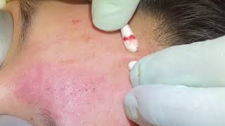 Favorite extractions 6 Blackheads whiteheads juicy pore pops Qtip removals Waxy plugs cleared [upl. by Idona775]